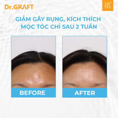 SPIDERMA + SPICULE I Tinh chất dưỡng ẩm da đầu  Spiderma Spicule-12 lọ x 5ml