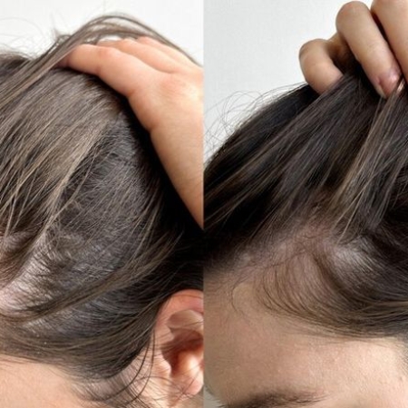 7 Mẹo Giúp Tóc Mọc Lại Nhanh Chóng, Không Tốn Nhiều Chi Phí