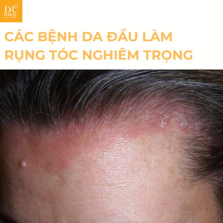 Các Bệnh Da Đầu Gây Rụng Tóc