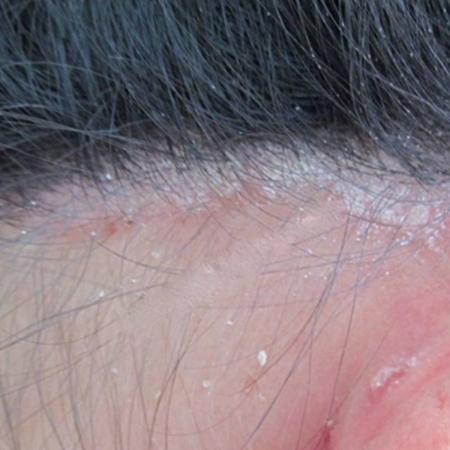 Tại sao da đầu khỏe là chìa khóa cho mái tóc dày và đẹp?