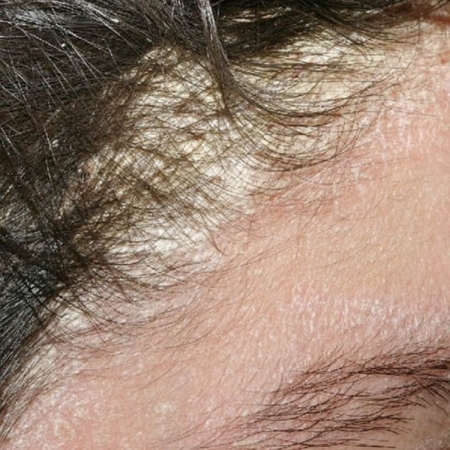 Tầm quan trọng của việc làm sạch da đầu