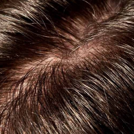 Da đầu nhờn có nên dùng xịt dưỡng không? Giải đáp chi tiết