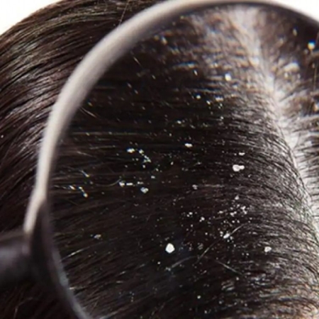 Da đầu nhiều gàu phải làm sao?