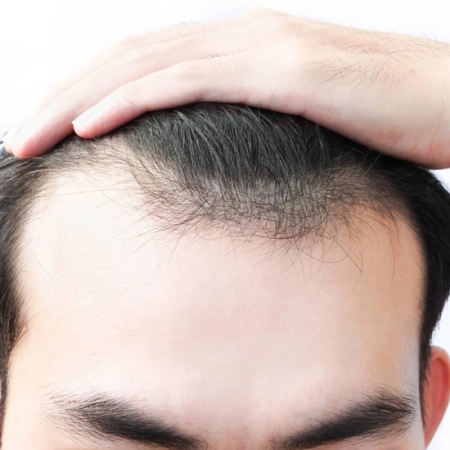 Các Công Nghệ Mọc Tóc Tiên Tiến Hiện Nay: Giải Pháp Cho Người Bị Hói Đầu Nặng