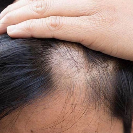 Tóc yếu mỏng: Giải pháp phục hồi hiệu quả