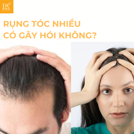 Rụng Tóc Nhiều Có Hói Không