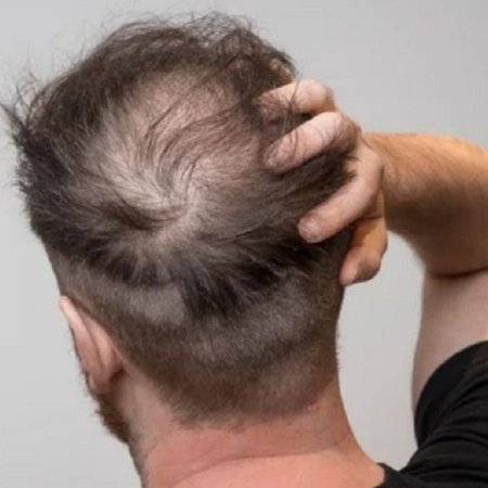 Câu chuyện khách hàng: Lột xác ngoạn mục sau khi dùng Dr.Graft