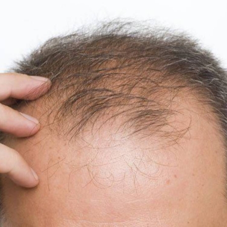 Hướng dẫn chăm sóc tóc cho nam giới bị rụng tóc sớm