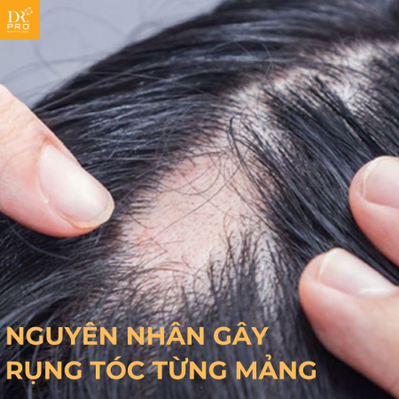 Rụng Tóc Từng Mảng: Dấu Hiệu, Nguyên Nhân Và Phương Pháp Điều Trị