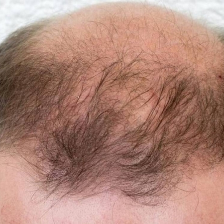 Sản phẩm chăm sóc tóc dành cho người bị hói đầu