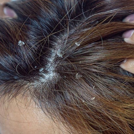 Tẩy da chết da đầu: Vì sao quan trọng?