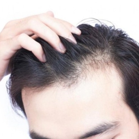 RỤNG TÓC Ở NAM GIỚI: CẢNH BÁO HÓI ĐẦU