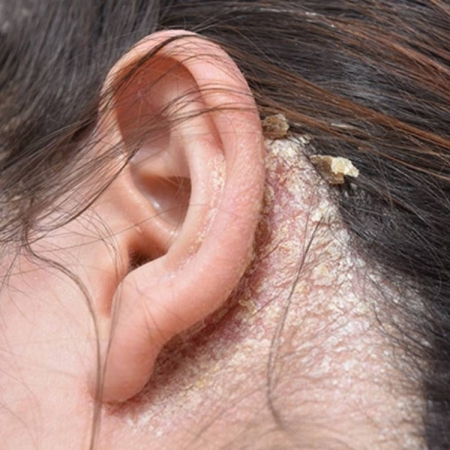 Sản phẩm dành cho người bị viêm da tiết bã nhờn ở da đầu