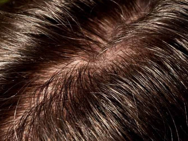 Da đầu nhờn có nên dùng xịt dưỡng không? Giải đáp chi tiết