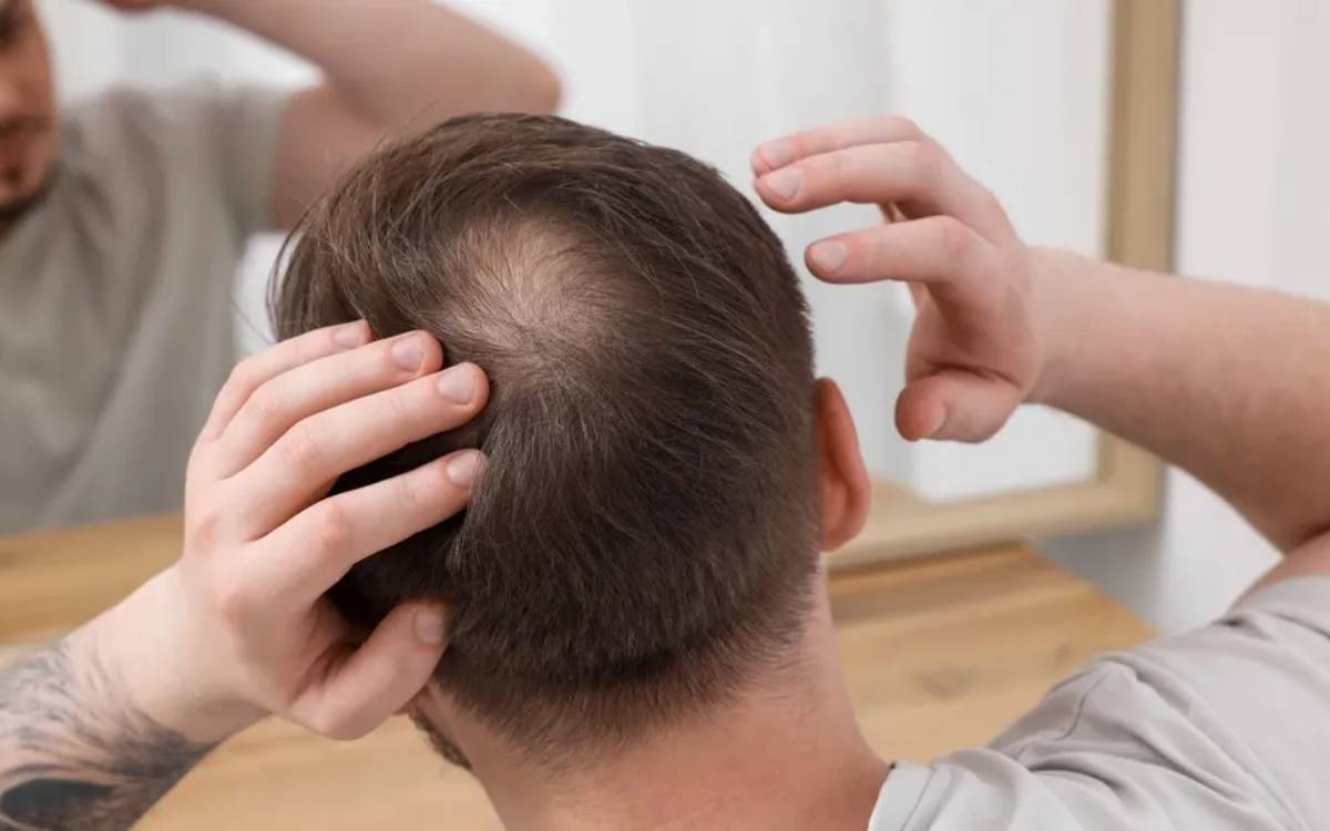 Hiện nay nhiều người đang mắc phải tình trạng hói đầu di truyền
