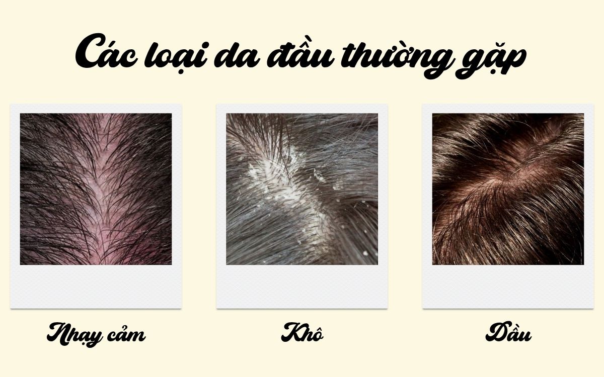 Một số loại da đầu thường gặp