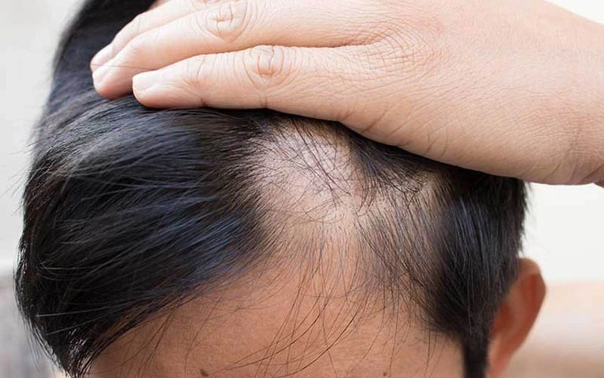 Phần lớn người có tóc yếu mỏng là do yếu tố di truyền